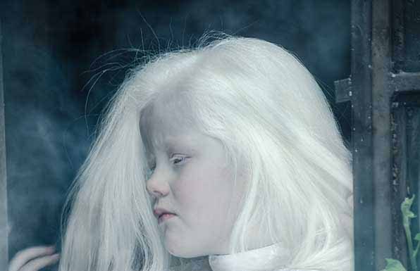 Albinismo. Mitos e tabus na série Invisíveis